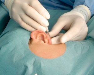 عوارض و مزایای جراحی گوش
