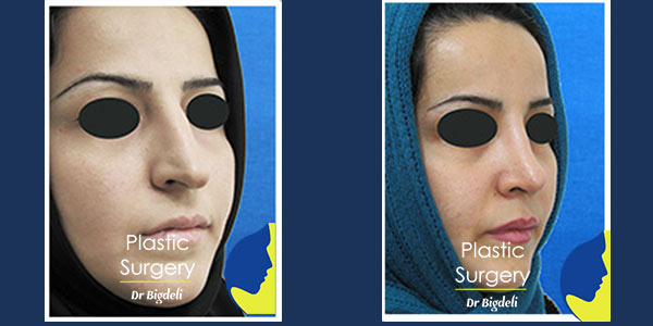نوع پوست در نتایج جراحی بینی