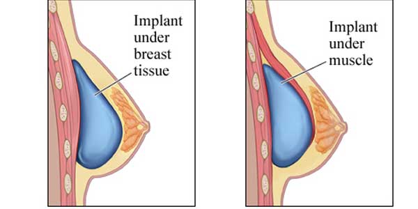 implant-sine