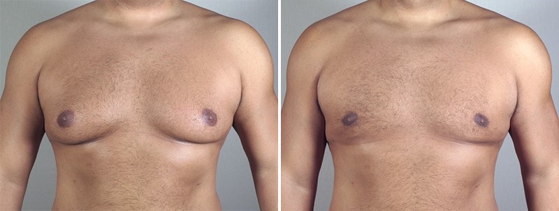 جراحی کوچک کردن سینه در مردان 